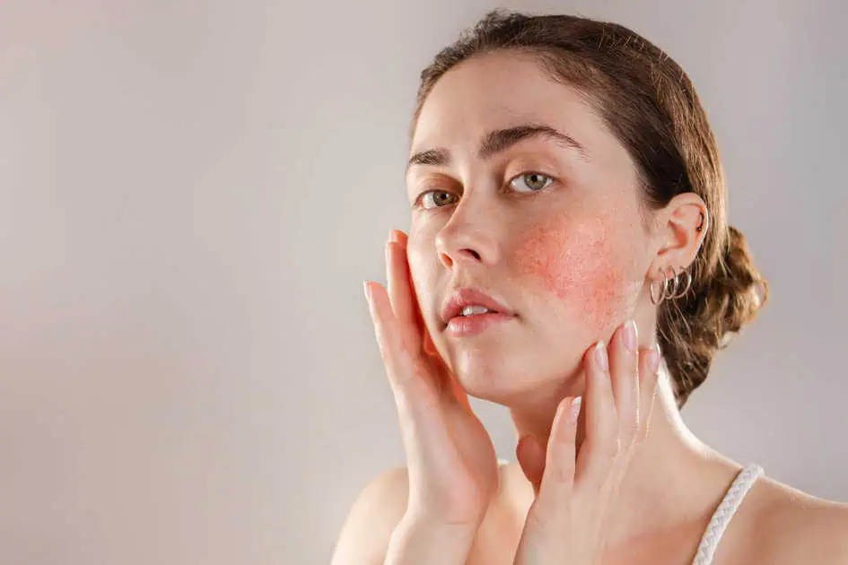 Laser Therapy for Rosacea Redness Removal in Portsmouth, NH by LIIV Medical Aesthetics