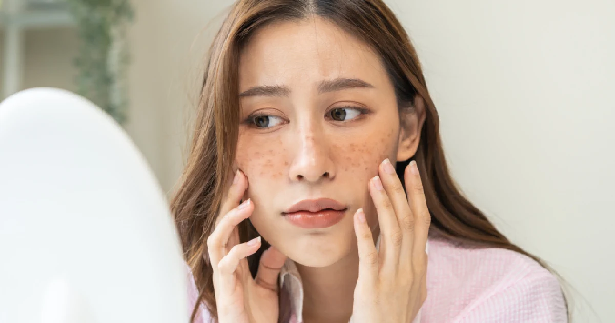 Women need effective acne treatment in Portsmouth, NH