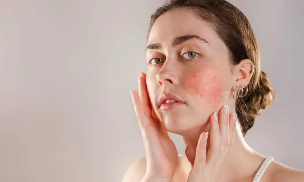 Laser Therapy for Rosacea Redness Removal in Portsmouth, NH by LIIV Medical Aesthetics