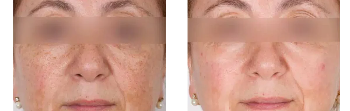 Photofacial - Sun Damaged Skin (face)