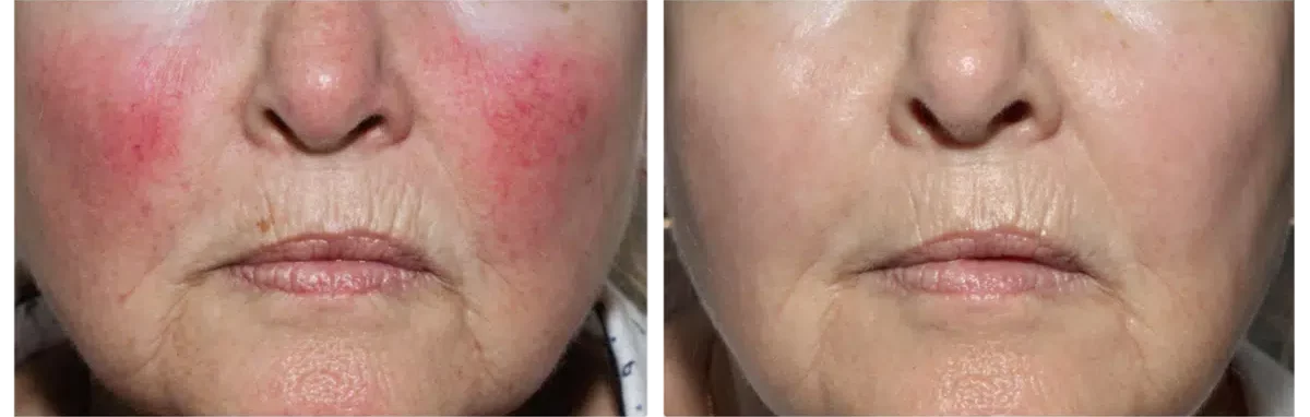 Rosacea