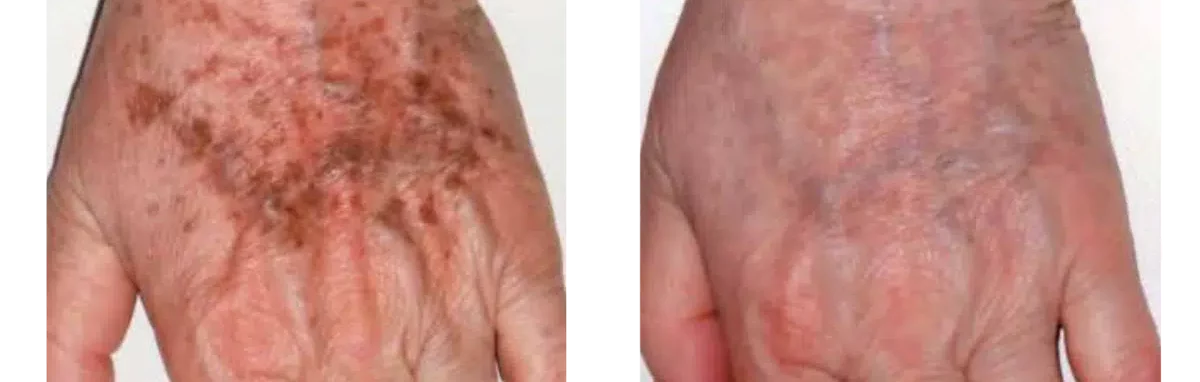 Sun Damaged Skin (hands)